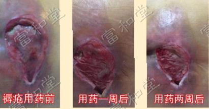 【真實(shí)案例】褥瘡使用富和堂徐氏燒燙傷保健膏康復(fù) 【真實(shí)案例】褥瘡使用富和堂徐氏燒燙傷保健膏康復(fù)